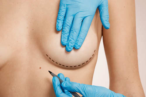 Paciente marcada para cirugía de mamoplastia