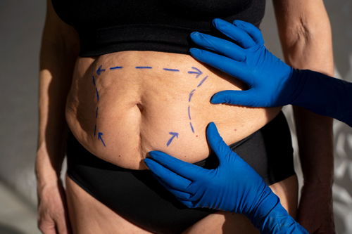 Mujer con abdomen marcado para cirugía de abdominoplastia